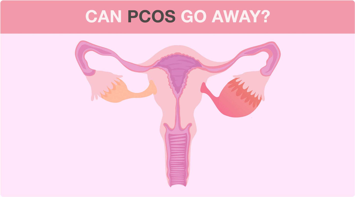 Does PCOS Ever Go Away?